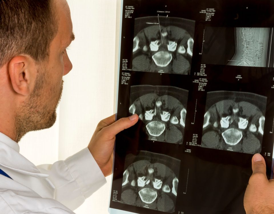 Doctor holding MRI scan of spinal disc