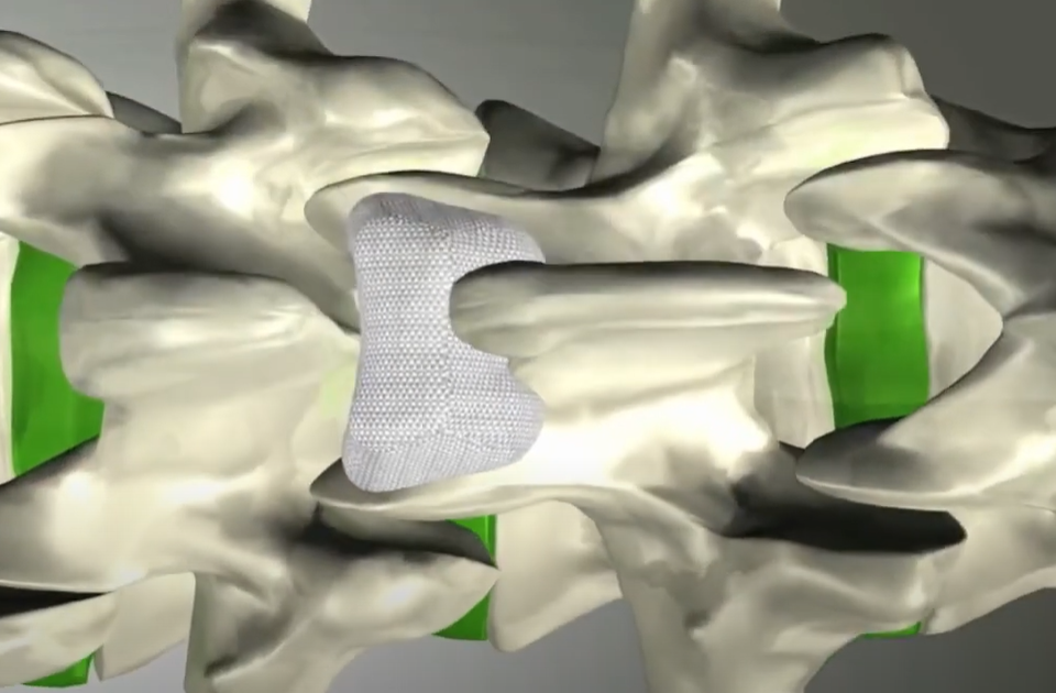 Intraspine 16 intraspine-implant