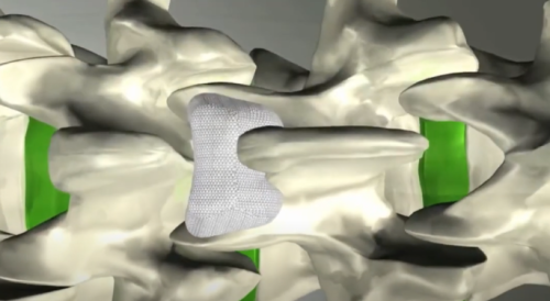 intraspine-implant
