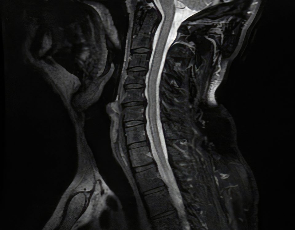 Magnetic resonance imaging showing cervical spine and spinal cord