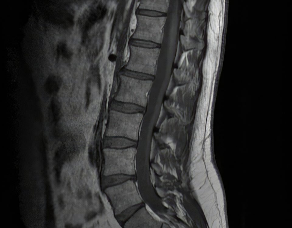 Magnetic resonance imaging showing healthy lumbar spine and spinal cord