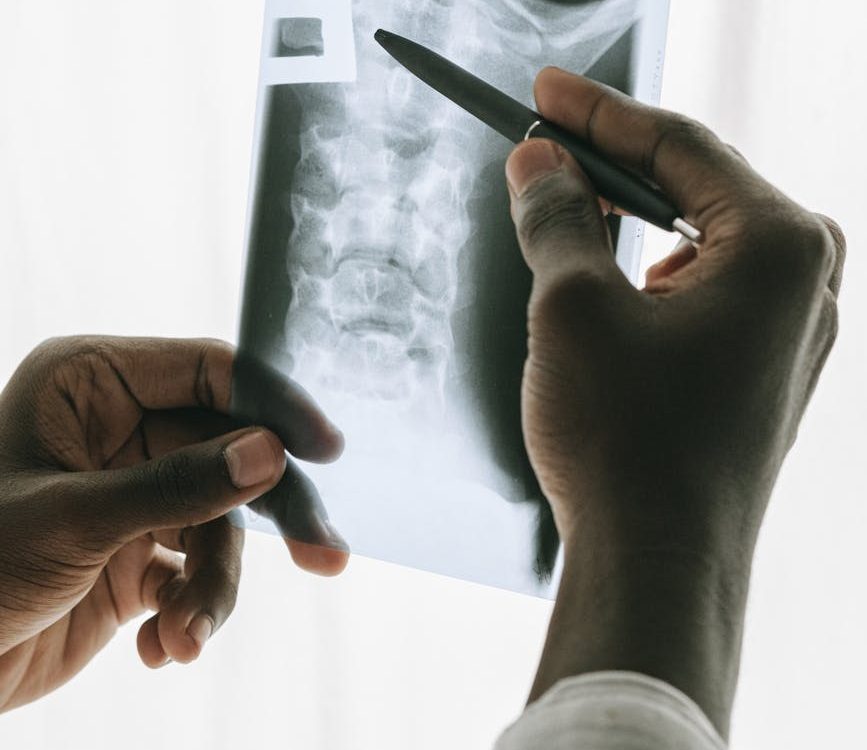 person holding black pen and an x ray