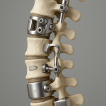 découvrez les implants innovants tops™, intraspine® et esp : explications claires pour patients québécois sur leurs avantages, indications et fonctionnement.